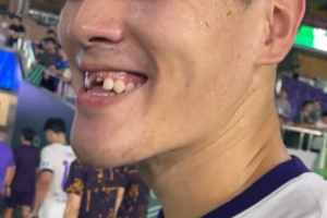 记者:王献均门牙留在了黄龙体育中心,很多人一起找都没找到 记者:王献均门牙留在了黄龙体育中心,很多人一起找都没找到